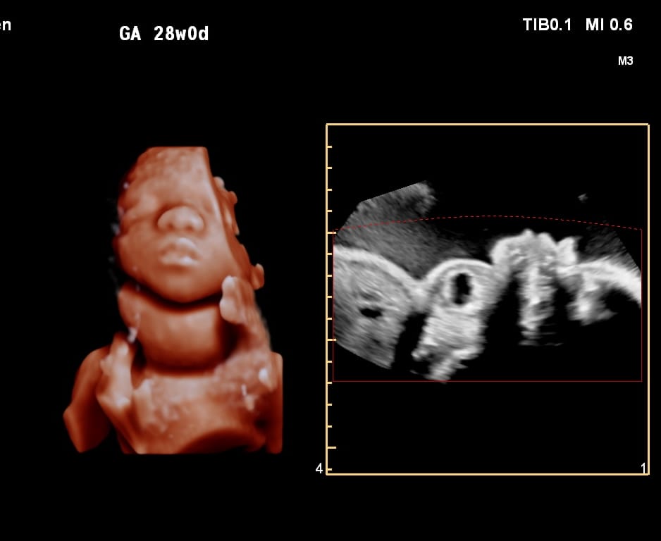 Abdominal ultrasound